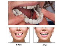 Carillas Dentales Superiores E Inferiores 2022 Nuevo Blanqueamiento Sonrisa Perfecta Para Adultos