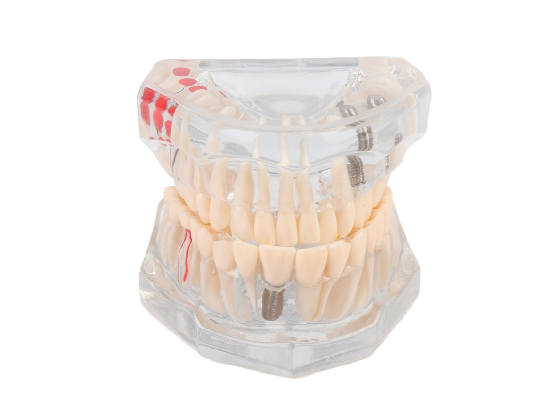 Modelo Dental Didáctico Con Encía Transparente Y Estructura Clara.