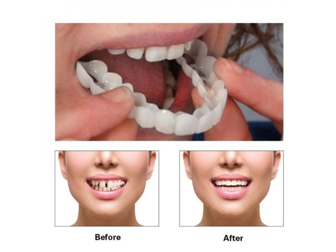 Protector dental superior e inferior de silicona blanca listo para usar, de fácil colocación. Herramienta cosmética CDT.