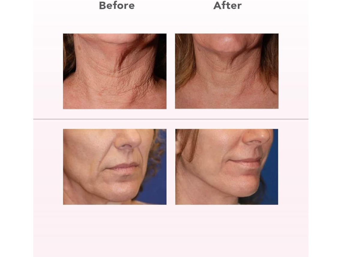 Dispositivo de estiramiento de la piel con matriz de puntos infrarrojos SkinLift, aparato de belleza para reafirmar la piel y eliminar arrugas - CHRONUS
