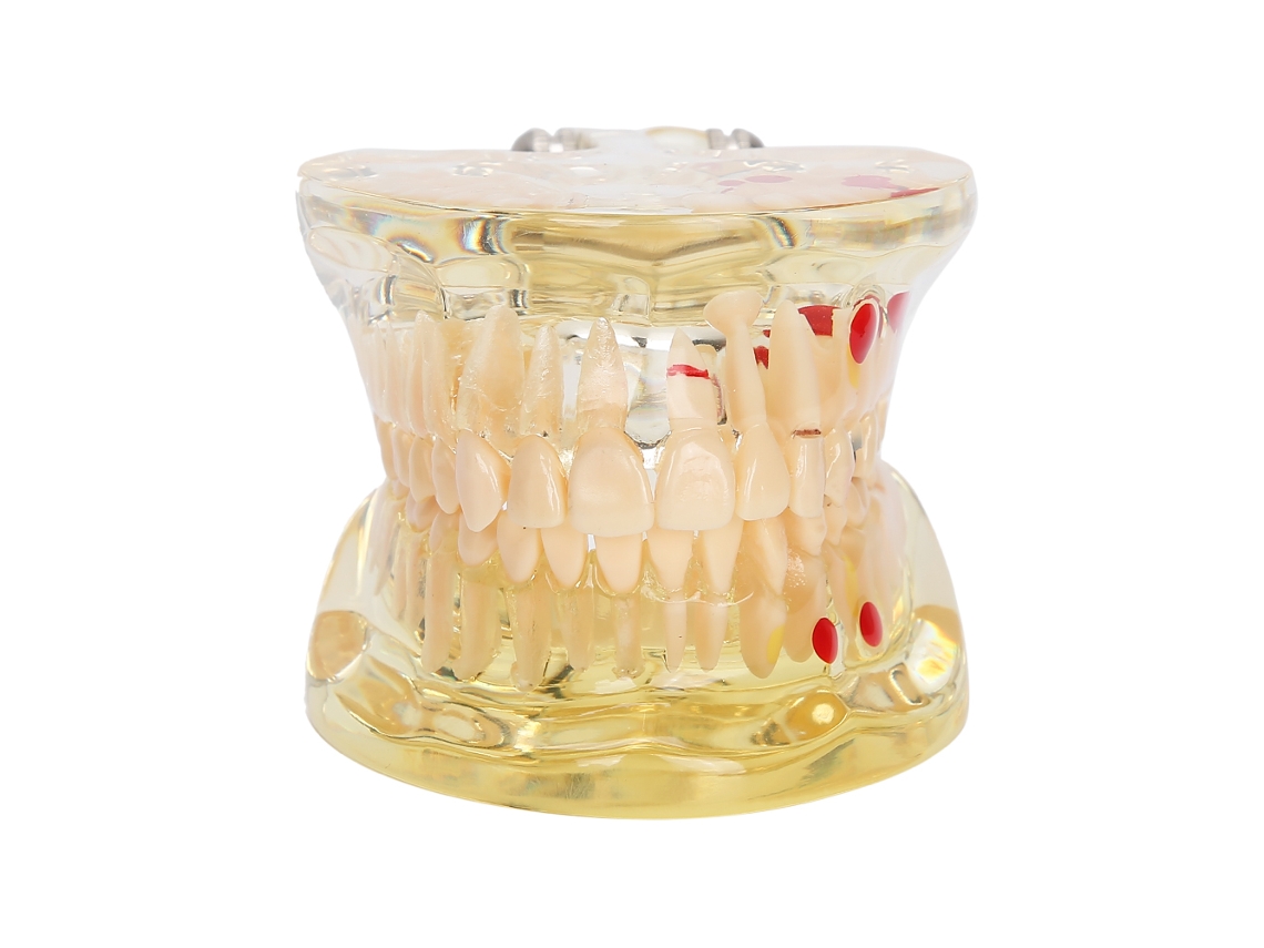 KOFIHETY Modelo Dental de Diente Patológico Extraíble, Herramienta de Enseñanza para Dentistas