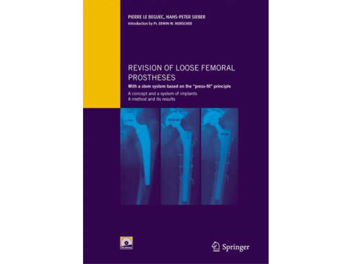 Libro Revision of loose femoral prostheses with a stem system based on the "press-fit" principle (Inglés)