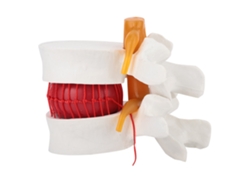 Modelo De Hernia Discal Lumbar Humana A Escala 1:1.5 De Vértebras Lumbares Para La Enseñanza Médica.
