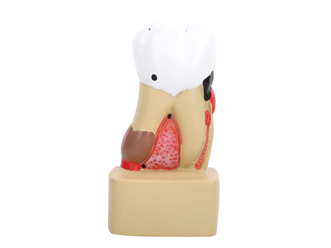Modelo Dental Para El Estudio Y La Enseñanza De Enfermedades Patológicas Integrales Y Caries Dental (1 Unidad)