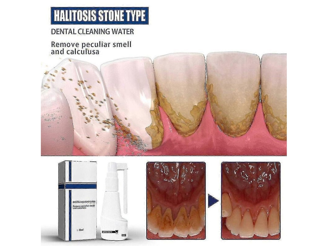 Spray Disolvente De Sarro Para Dientes Con Blanqueamiento Instantáneo Y Eliminación De Manchas.
