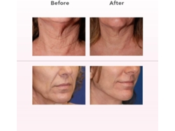 Dispositivo de estiramiento de la piel con matriz de puntos infrarrojos SkinLift, aparato de belleza para reafirmar la piel y eliminar arrugas - CHRONUS