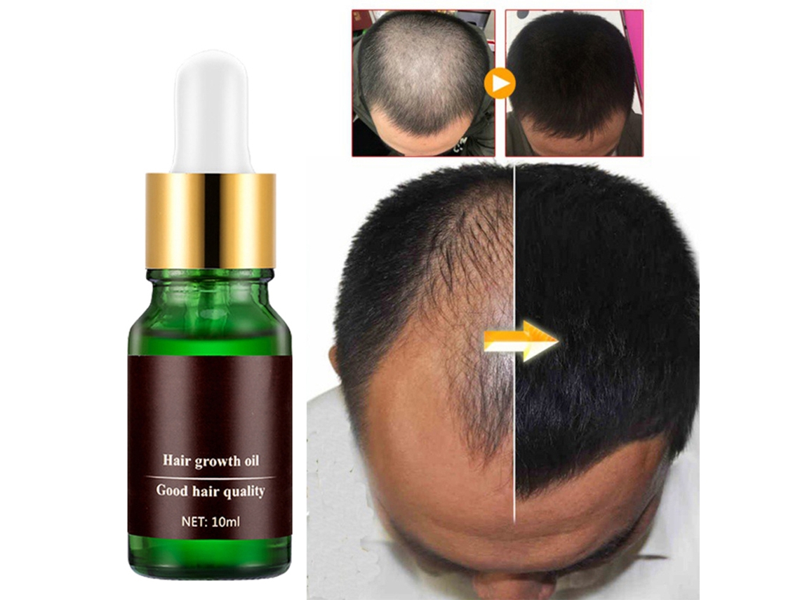 Aceite Para Crecimiento Capilar Natural Sin Efectos Secundarios Para Detener La Caída Y Regenerar Cabello Más Rápido