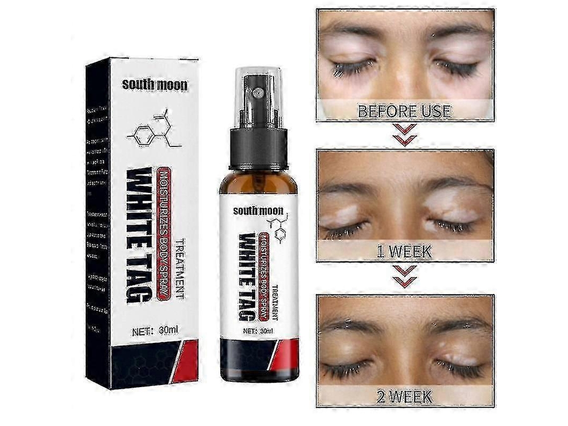 Vitiligo Treatment Spr