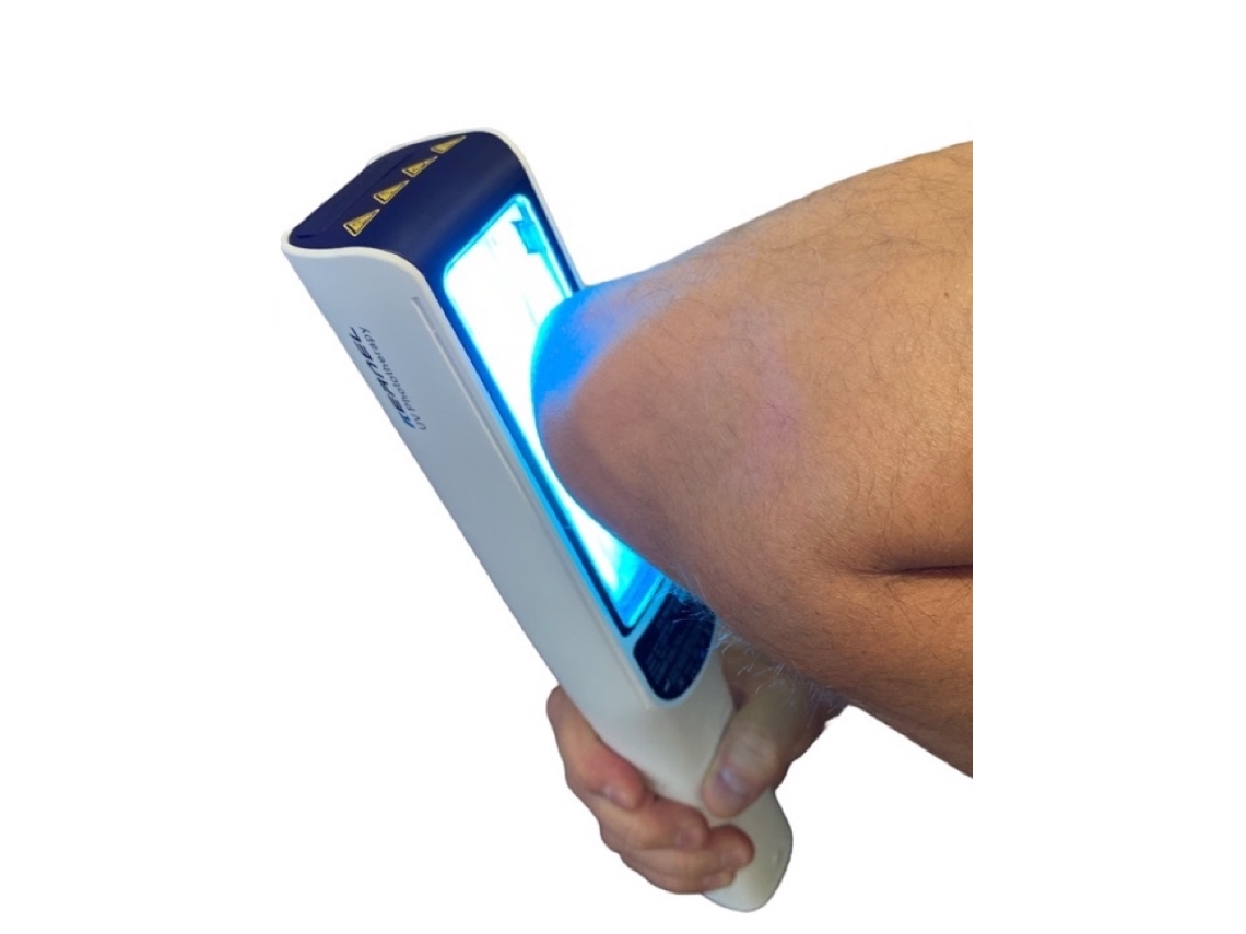 Lámpara de fototerapia UVB de 311 nm para enfermedades de la piel, psoriasis, vitíligo y eczema.