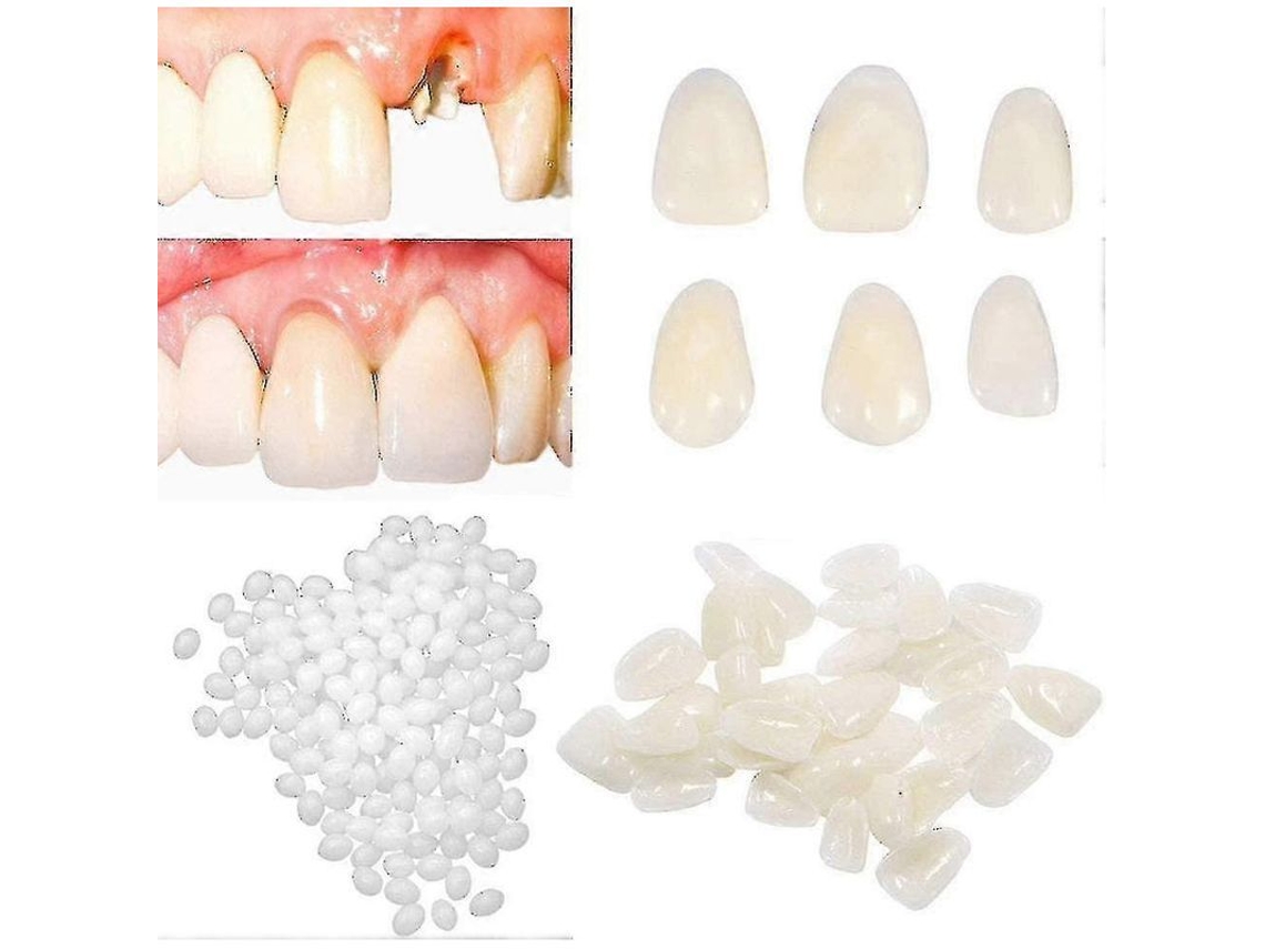 Kit Temporal De Reparación Dental (2 Piezas) Para Rellenar Dientes Rotos, Faltantes O Con Espacios - Dientes Postizos Moldeables