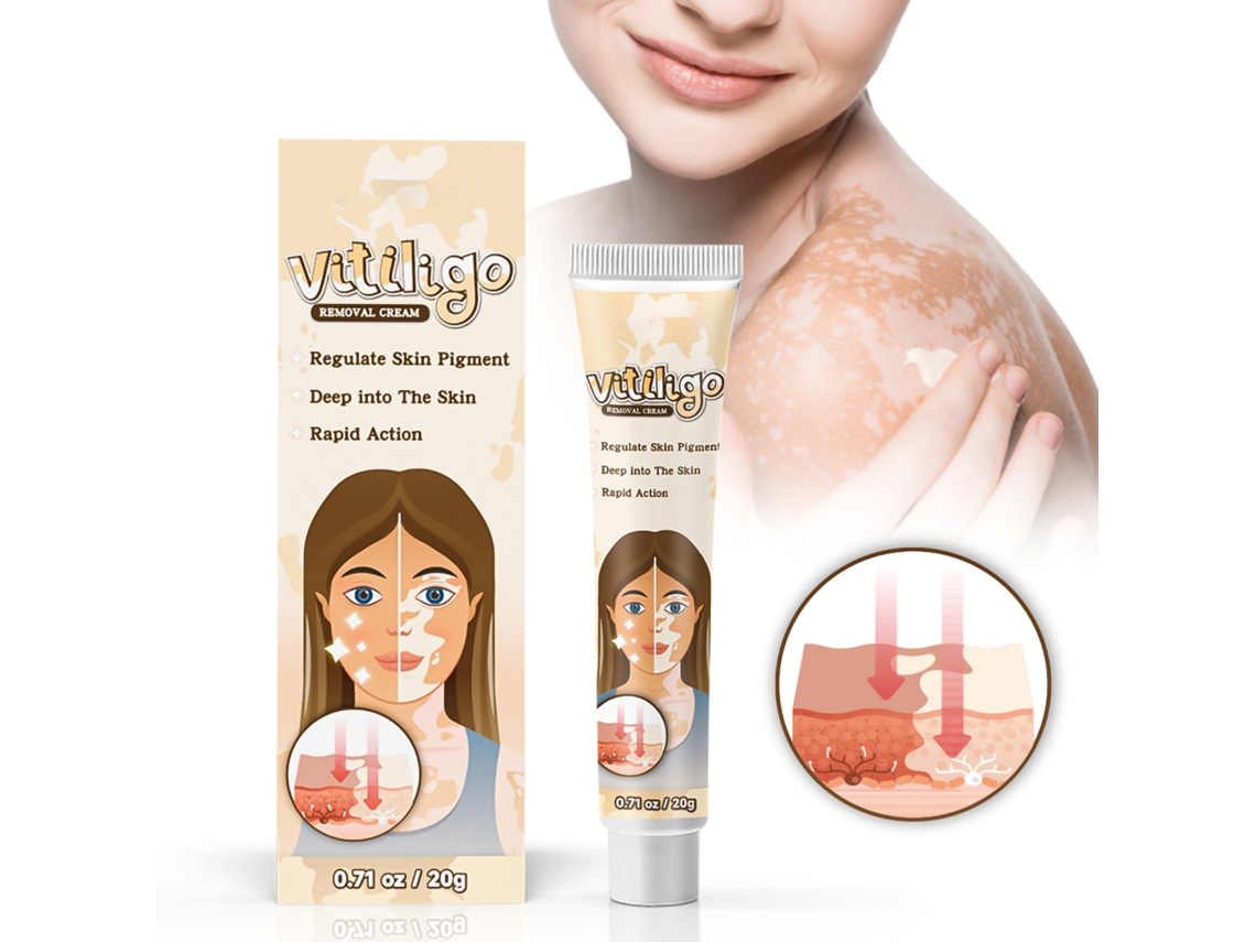 Crema Herbal Para Vitiligo Con Manchas Blancas Piebald 20g Regula Pigmentación Y Protege La Piel
