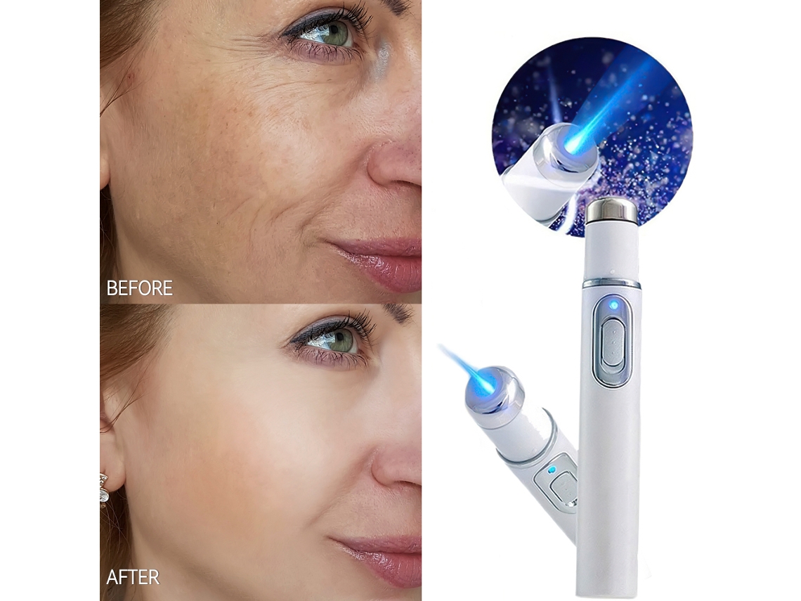 Lápiz láser Eifson para eliminar acné y arrugas, manchas en la piel y terapia de luz azul.