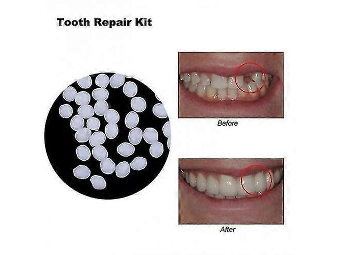 Kit De Restauración Dental: Adhesivo De Resina Sólida Para Prótesis Dentales, 50 G.