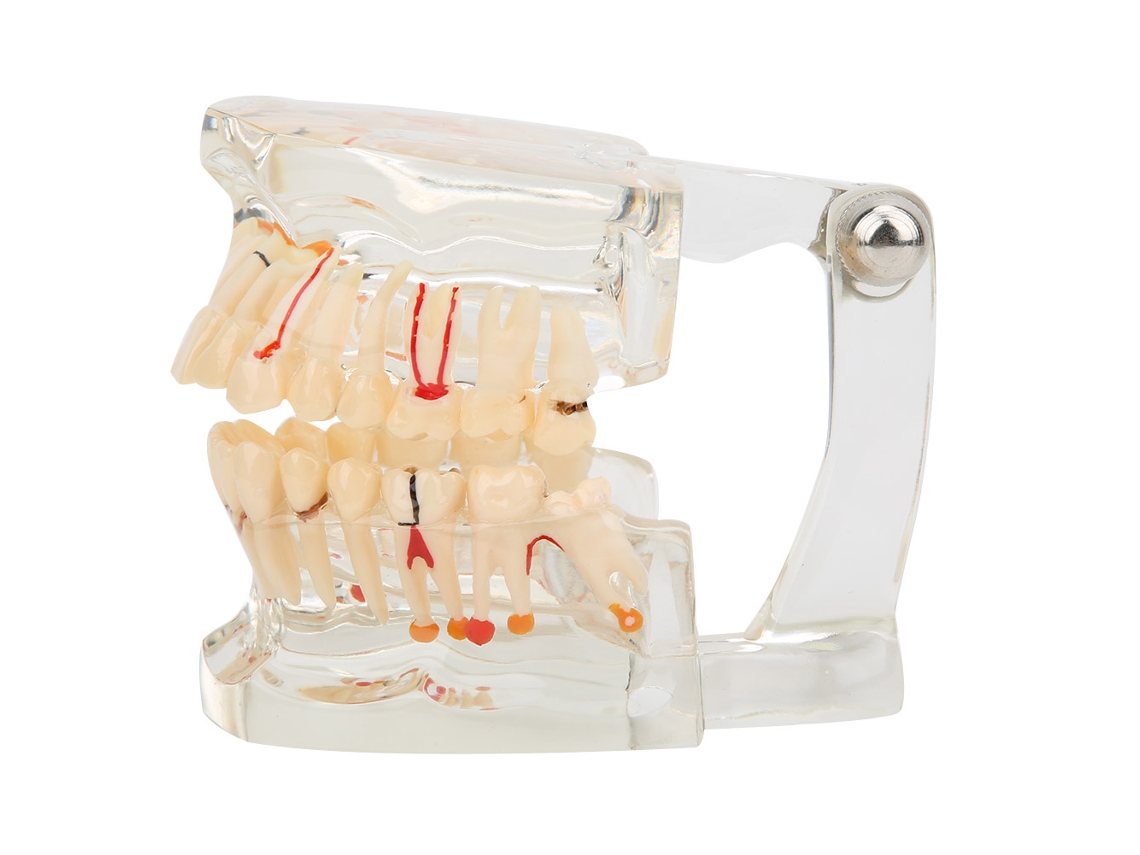 Modelo Transparente De Implante Dental Para La Enseñanza Y El Estudio Hospitalario.