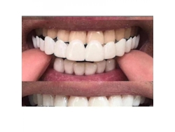 Cubre Temporalmente Los Dientes Deformados Y Rotos Con Snap On Smile Veneer: Cómodo Y Ajustable.