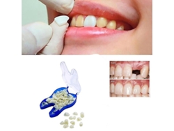 Prótesis Dentales Superiores Temporales, Carillas, Dientes Faltantes, Dientes Rotos Y Espacios Interdentales.
