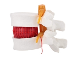 Modelo De Demostración De Hernia Discal Lumbar Humana A Escala 1:1,5 Para Enseñanza Y Demostración Médica.
