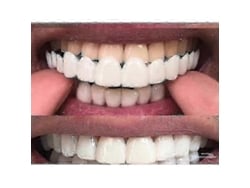 Dispositivos flexibles para blanquear prótesis dentales Ajuste cómodo Dientes superiores/inferiores Yuhao