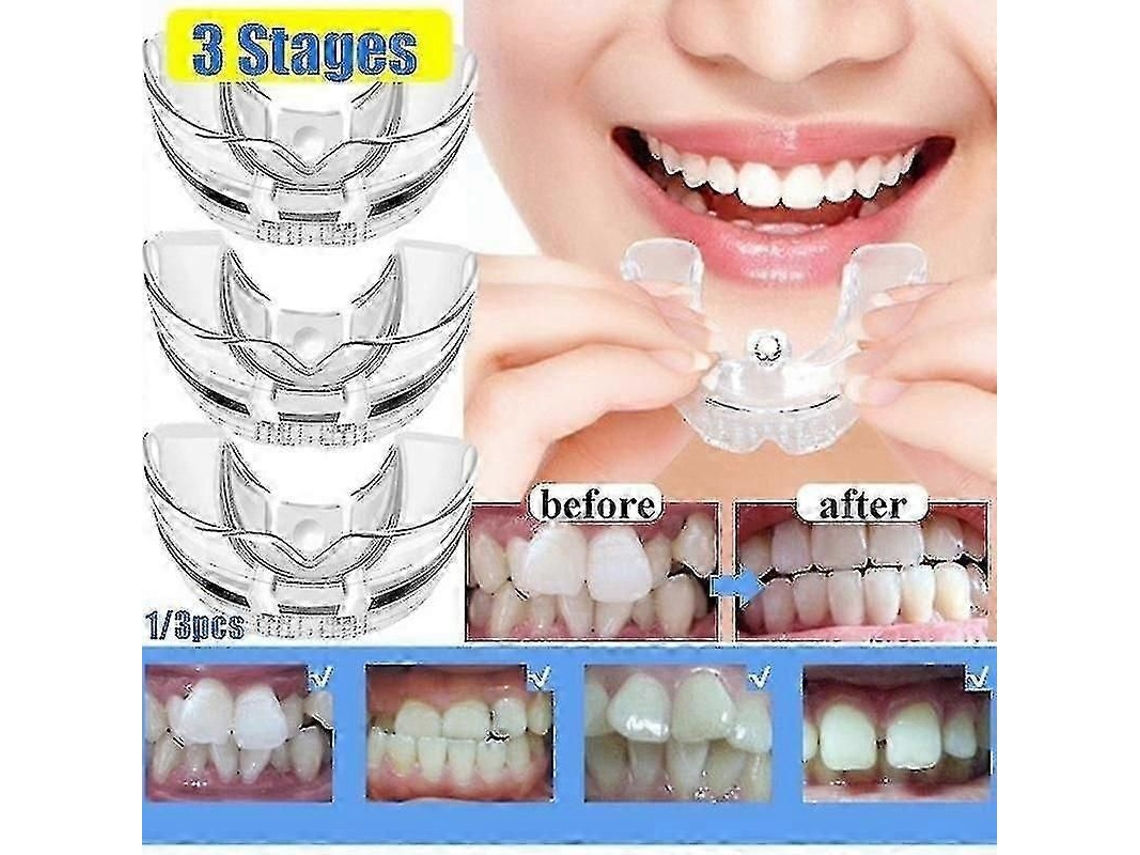 Retenedor Dental De Silicona Para Adultos, Etapas 1-3, Corrector Dental Transparente/azul, 2024