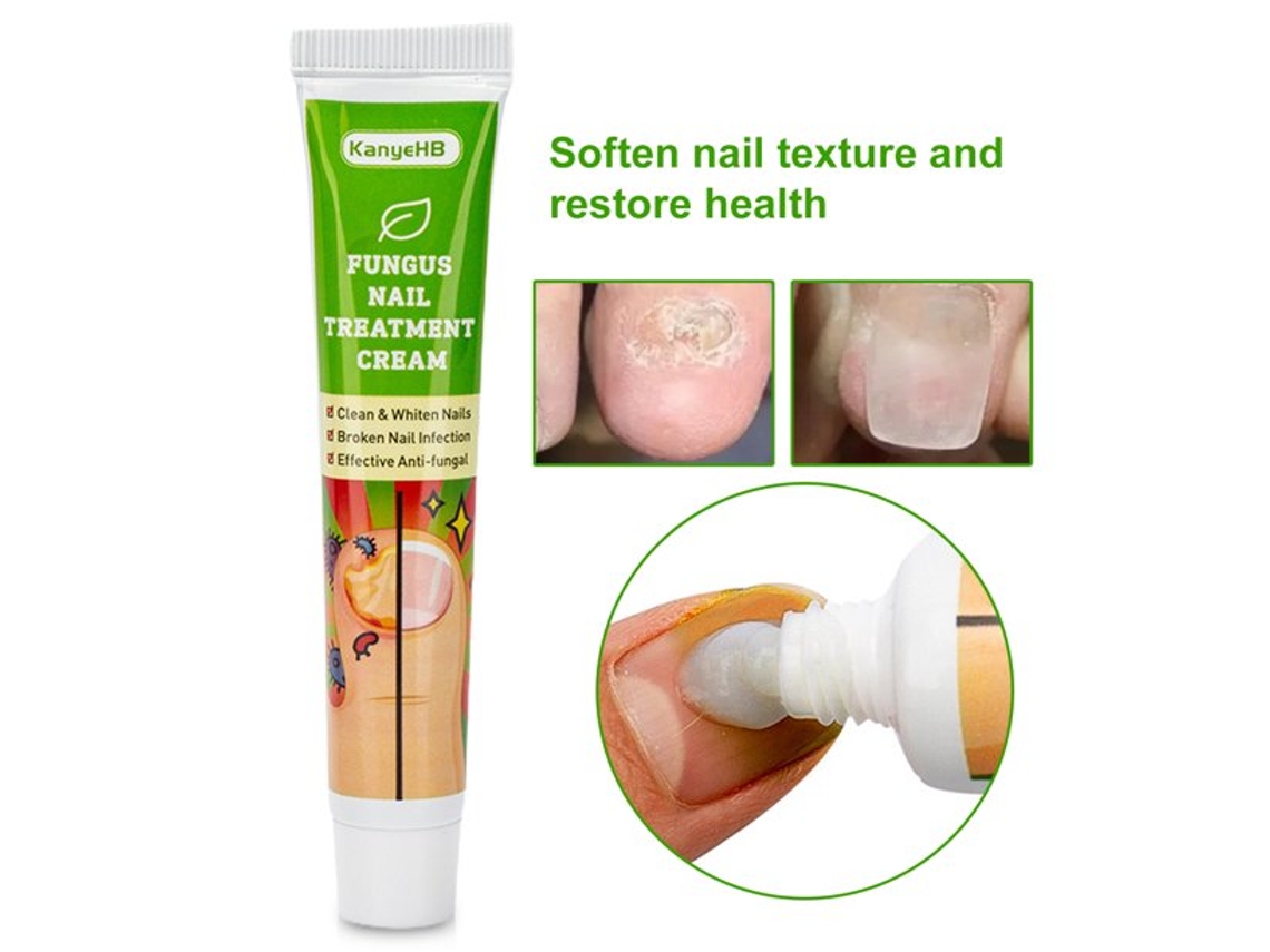 Tratamiento de uñas de 20g, pomada para eliminar la onicomicosis paroniquia, yeso para el cuidado de los dedos de los pies, solución para hongos en las uñas para Toenai