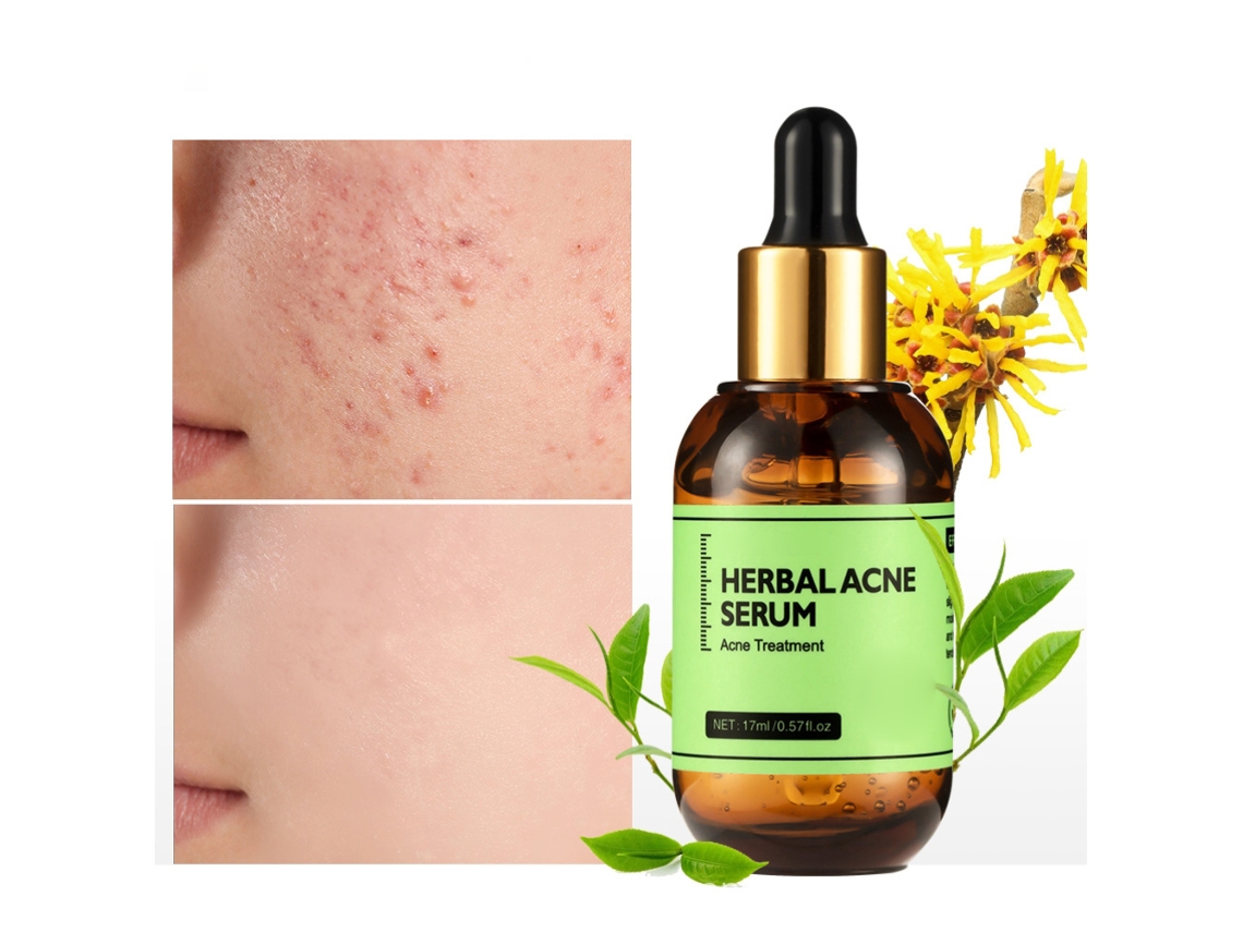 Sérum antiacné para controlar la grasa y reducir las cicatrices del acné.