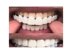 Recortador De Dientes Blanco Flexible Y Cómodo Para Dientes Superiores E Inferiores