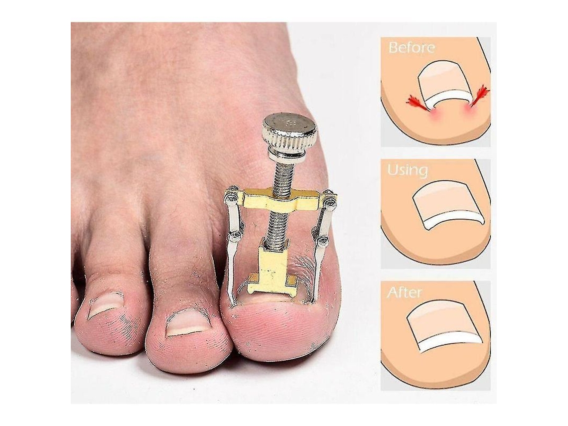 Dan26-herramienta Correctora De Uñas Encarnadas Clip Para Pie Manicura Pedicura Cuidado De Pies Acero Carbono