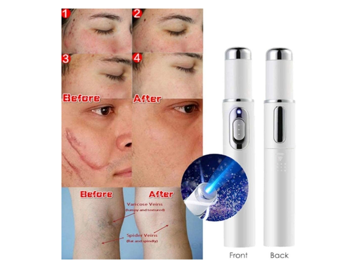 Lápiz de terapia de luz azul para eliminar arañas vasculares, acné, cicatrices, arrugas, hinchazón de ojos y ojeras.