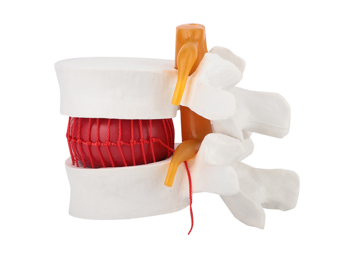 Modelo De Hernia Discal Lumbar Humana A Escala 1:1.5 De Vértebras Lumbares Para La Enseñanza Médica.