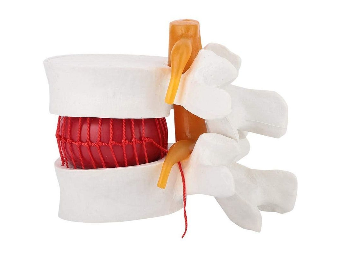 Modelo De Demostración De Hernia Discal Lumbar Humana A Escala 1:1,5 Para Enseñanza Y Demostración Médica.