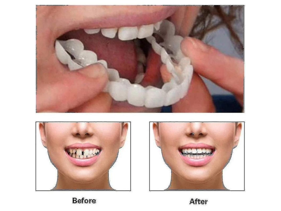 Carillas Dentales Superiores E Inferiores 2022 Nuevo Blanqueamiento Sonrisa Perfecta Para Adultos