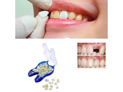 Prótesis Dentales Superiores Temporales, Carillas, Dientes Faltantes, Dientes Rotos Y Espacios Interdentales Mhx