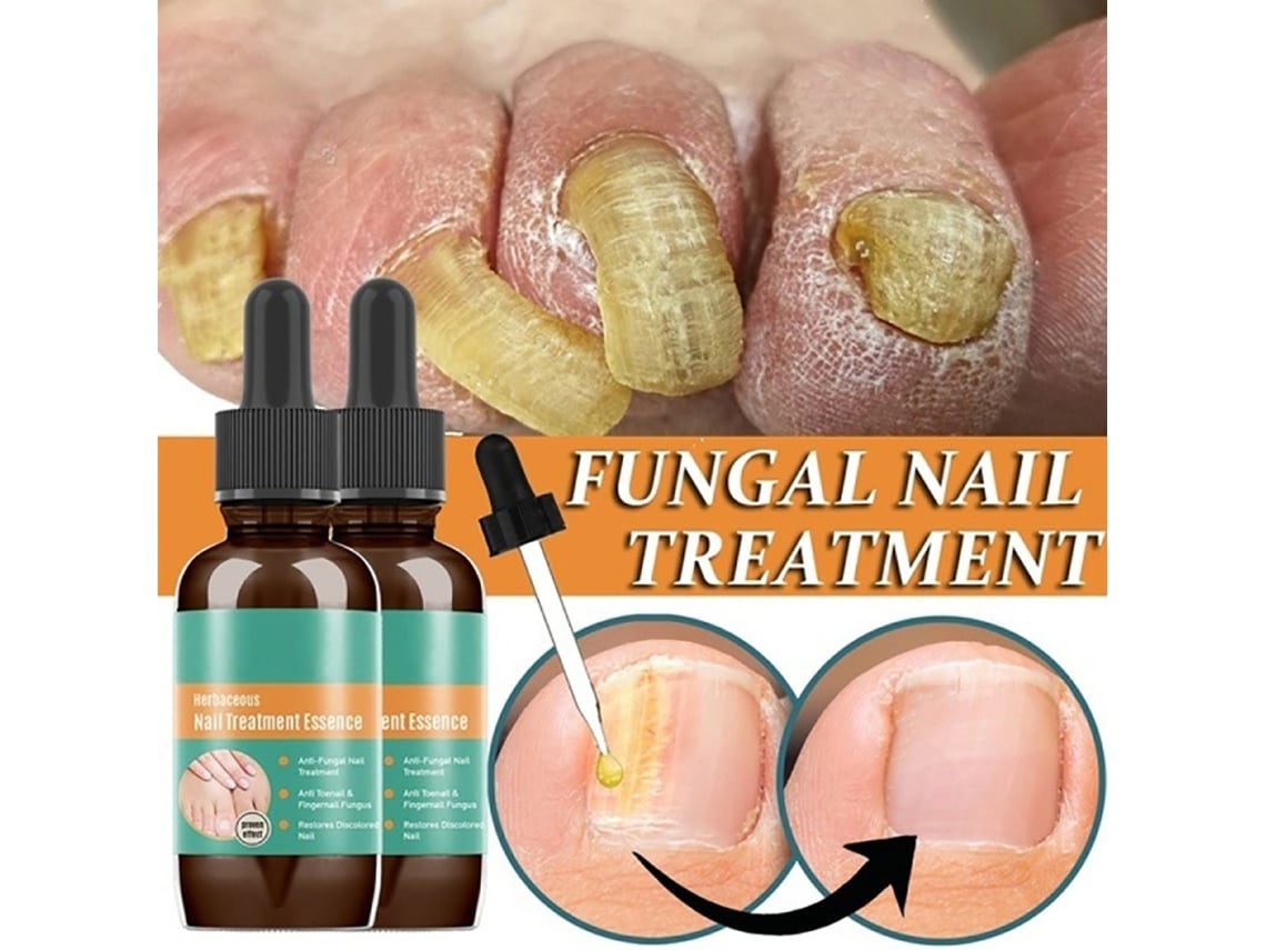 30ml Líquido Antifúngico Para Unhas De Dedos E Pés Com Ingredientes Suaves E Design De Pincel Pequeno